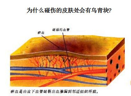 为甚么碰伤的皮肤处会有铁青块