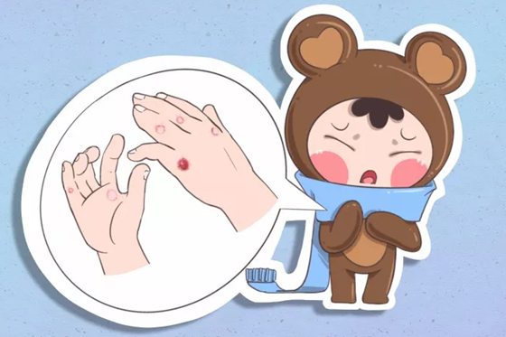 报酬甚么会生冻疮,生冻疮怎样办