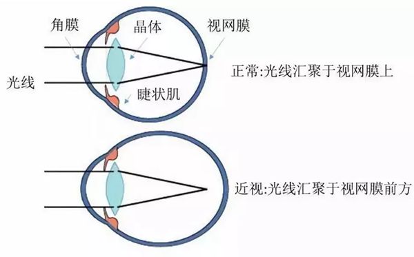 报酬甚么会远视,远视眼构成的道理是甚么