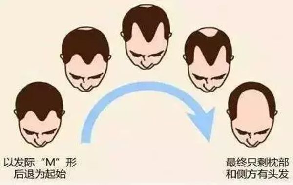 发际线为甚么会后移,发际线后移该怎样办
