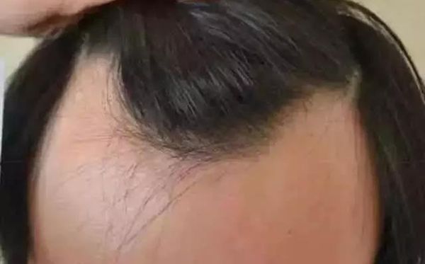 发际线为甚么会后移,发际线后移该怎样办
